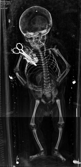 Röntgenaufnahme von Sarg 7. Die Schere liegt auf dem Sargboden unter dem Säugling. Foto:  Universität Bern, Institut für Rechtsmedizin, Abteilung Anthropologie
